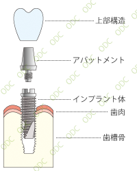 インプラントの構造