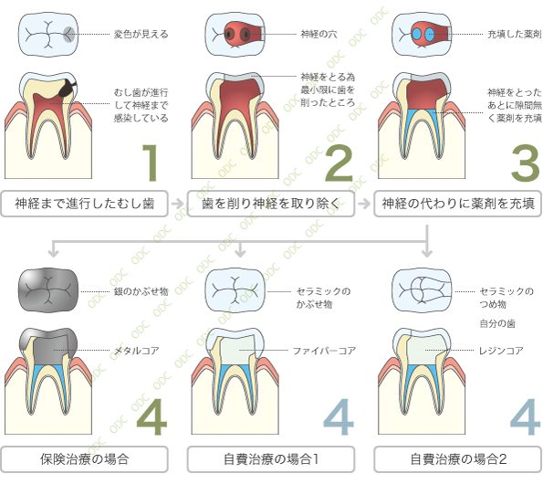 神経をとらないといけなくなった歯に対する治療の流れ