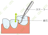 歯石除去